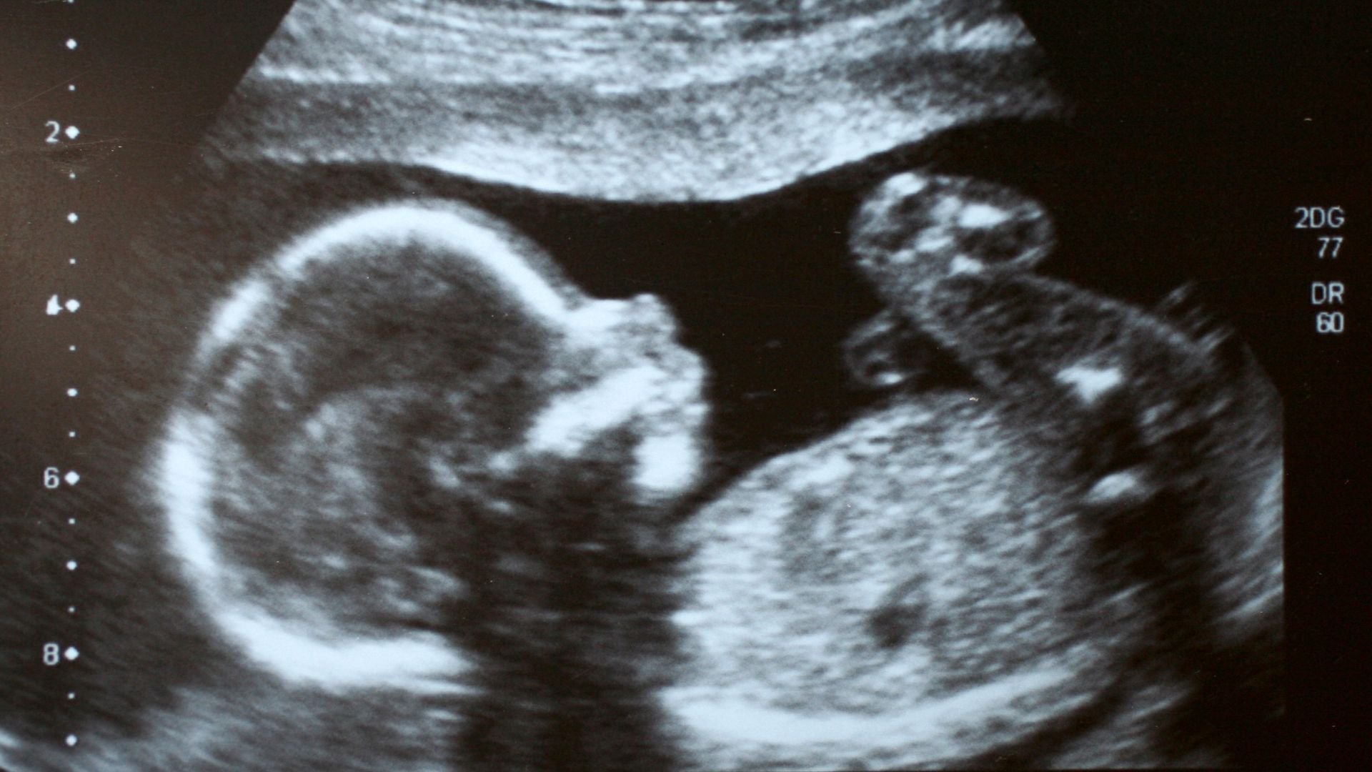 سونوگرافی سه ماهه دوم جنین