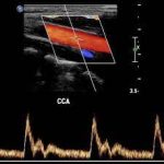 سونوگرافی داپلر چیست و چه کاربردی دارد