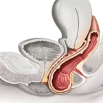 افتادگی واژن چیست و چگونه درمان می‌شود؟