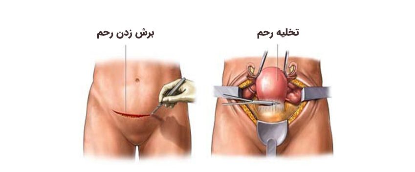 جراحی برداشتن رحم با دکتر فاطمه صالحی در تهران