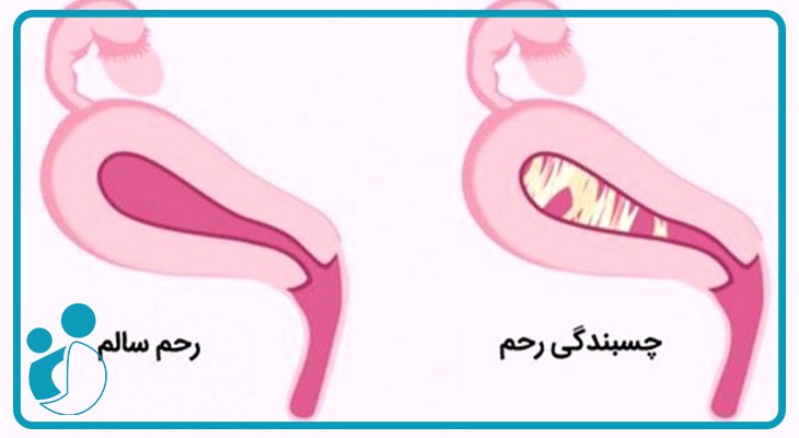 چسبندگی رحم | علت، علائم