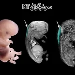 سونوگرافی NT چیست