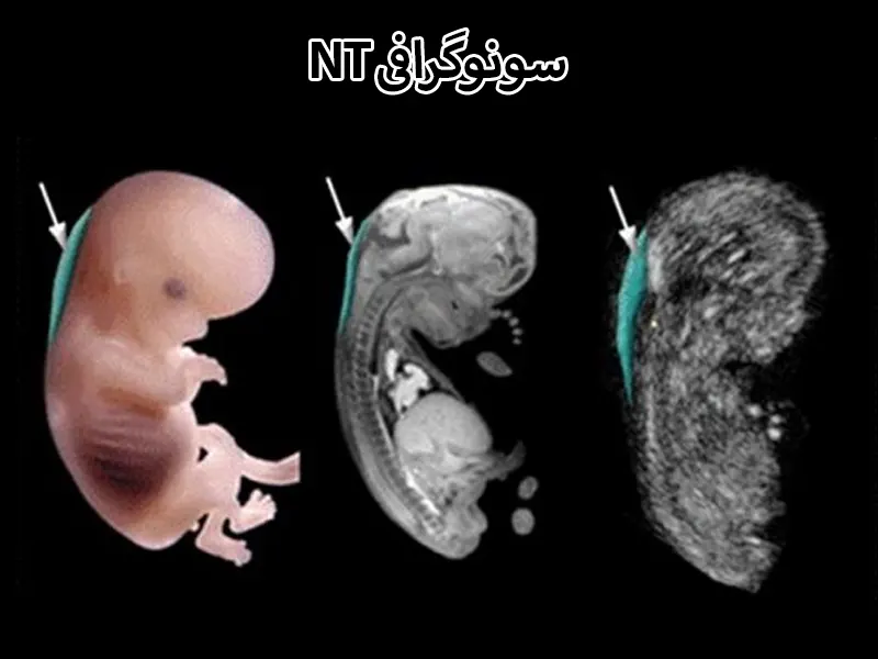 سونوگرافی NT چیست