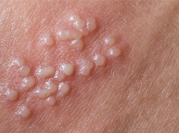 تبخال تناسلی در بارداری: آیا جنین در خطر است؟